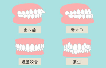 治療対象の歯並び