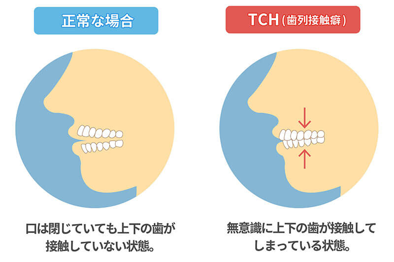 歯列接触癖TCH