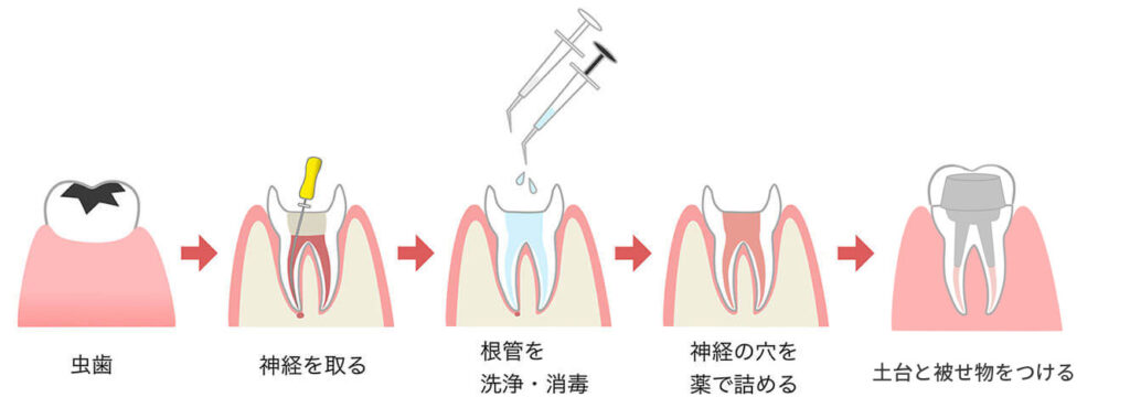 根管治療の流れ