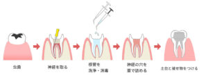 根管治療の流れ